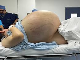 Woman Has 70 Pound Cyst Removed From Her Ovaries
