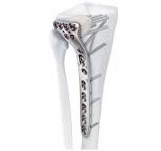 Variable Angle LCP™ Proximal Tibia Plate | Products | DePuy ...
