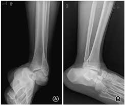 Image result for Subtalar Dislocation
