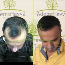 They all seem to be under the impression that we will be unable to help them solve the hair loss problems that they have by successfully giving them an fue hair transplant. Fue Hair Transplant The Best 76 Clinics Price S Doctors And Reviews