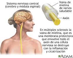 La esclerosis múltiple es una enfermedad autoimune en que el sistema inmunológico ataca la vaina de mielina, que es una estructura protectora que reviste a las neuronas, causando destrucción o daños permanentes en los nervios. Esclerosis Multiple Medlineplus Enciclopedia Medica