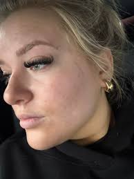 Affordable skin assessments for acne?