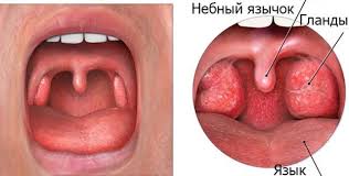 Vospalenie Yazychka V Gorle Simptomy Prichiny I Lechenie V Domashnih Usloviyah Gorodskaya Klinicheskaya Bolnica 1