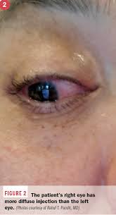 The evidence of ocular transmission has not been well studied. The Eyes Offer Conjunctival Clue To Covid 19