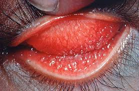 Image result for Gonococcal Conjunctivitis