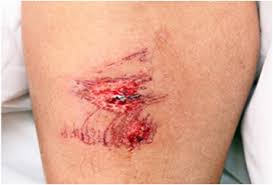 Graze wounds were made by handguns on the head and abdomen of white swine. Understanding The Healing Stages Of Wounds Advanced Tissue