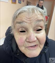 Multiple BCCs after Lisinopril Intake