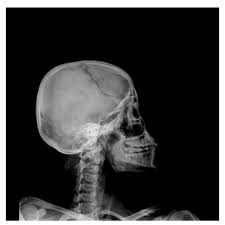 Image result for Skull XRay
