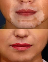 Treating Depigmentation