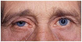 Horner Syndrome Clinical Perspectives Eb