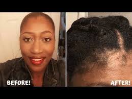 How To Regrow Edges And A Receding Hairline On Natural Hair Fast Daily Care Routine 2020 Youtube In 2020 Natural Hair Styles Regrow Hair Naturally Regrow Edges