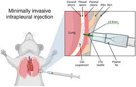 Image result for Intrapleural Anesthesia