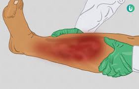 What is the differential diagnosis of cellulitis? Cellulitis Symptoms Causes Treatment Medicine Prevention Diagnosis