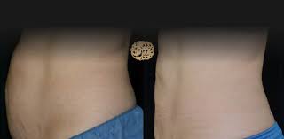 Maybe you would like to learn more about one of these? Coolsculpting Before And After Abdomen Flanks