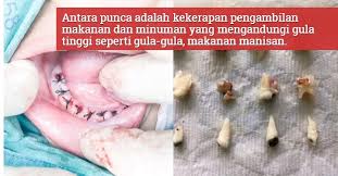 Cak mar mempunyai gigi yang berlubang, dari gigi berlubang ini seringkali membuat sakit saat makan ataupun minum. Usia Baru 2 Tahun Semua Gigi Susu Budak Ini Terpaksa Dicabut Kerana Menderita Karies Awal Kanak Kanak