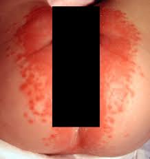 Image result for diaper dermatitis