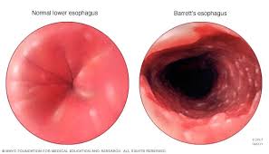 Image result for esophagus