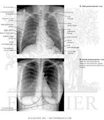 Image result for Chest XRay