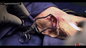 Cubital Tunnel Release Cadaver Journal Of Medical Insight