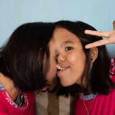 The Incredible Conjoined Twins Attached At The Head