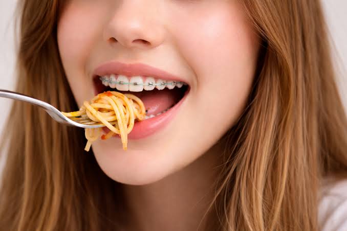 traditional metal braces