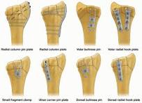 Fragment-Specific Fixation of Distal Radius Fractures ...