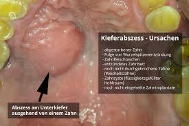 Die medikamentöse behandlung einer innenohrentzündung kann beispielsweise ergänzt werden durch infusionen mit durchblutungsfördernder wirkung. Kieferabszess Ursachen Symptome Behandlung