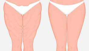 شد ترهلات الفخذين طرق تجمليه فعاله لازاله الترهلات صور حزينه