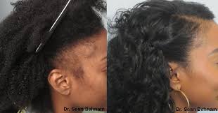 Hair transplant surgery hair restoration mens sunglasses celebrities style fashion swag moda celebs. African American Hair Transplants By Dr Sean Behnam