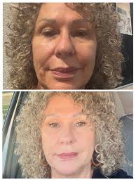 I am getting my upper bleph (& a rhinoplasty) done in Turkey in a month.  What do you recommend I take with me for after care & comfort. Note: I have  been