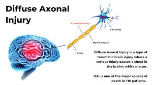 Image result for Diffuse Axonal Injury