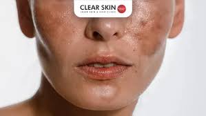 Image result for Melasma