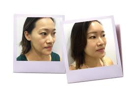 How to find a plastic surgeon in malaysia? Aesthetic Clinic Autologous Fat Transfer Face2 Laco