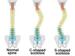 When you start your yoga practice to improve your scoliosis it's very important to know your curve pattern and be aware of your imbalances. What Is Scoliosis Causes And Treatment Options Toca The Orthopedic Clinic Association