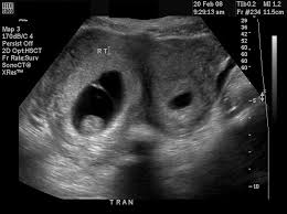 Diagnostic Ultrasound In The First Trimester Of Pregnancy