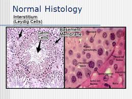 The first signs and symptoms of testicular cancer are a painless lump in the testicular area, unusual firmness in the affected testis or dull aching in the. Lecture 7 Pathology Of Testis Flashcards Quizlet