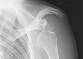 Image result for Chronic Shoulder Dislocation