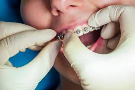 Early Orthodontic Treatment for Kids: 7 Reasons to Start Now