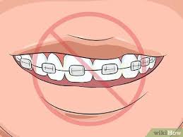 May 15, 2020 · 9 tren warna di tahun 2021. Cara Memilih Warna Behel Kawat Gigi 14 Langkah Dengan Gambar