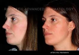 We may earn commission from links on this page, but we only recommend products we back. Rosacea Treatment Philadelphia Main Line Pa