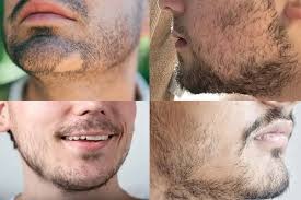 ‫کاشت ریش | نکات، مزایا، عوارض و قیمت‬‎