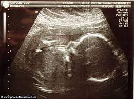 My Baby Wasn T Lazy He Was Dying Mother Blasts Hospital That Dismissed Her Concern About Lifeless Baby Scans And Ignored Her Request For Tests 22 Times Daily Mail Online