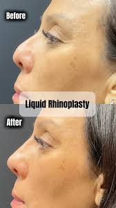 Non-Surgical nose job magic by PA Gilbert 🪄✨ These before and after Liquid  Rhinoplasty results speak for themselves😍 , -, #liquidrhinoplasty  #nonsurgicalrhinoplasty #nose #nosebeforeandafter ...