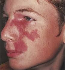 Petechiae are tiny red, flat spots that appear on your skin. Jarvis Ch 12 Vascular Purpuric Lesions Flashcards Quizlet