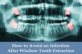 The removal of impacted wisdom teeth is a serious surgical procedure. How To Avoid An Infection After Having A Tooth Pulled Or Wisdom Tooth Extraction