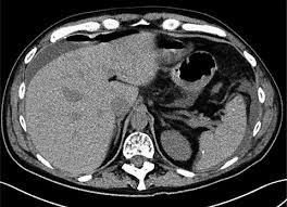 Grosicki, with 3 highly influential citations and 14 scientific research papers. Colon Perforation In Multiple Myeloma Patients A Complication Of High Dose Steroid Treatment Vaxman 2020 Cancer Medicine Wiley Online Library