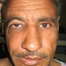 PDF) Rhinocerebral Mucormycosis: A Diagnostic Challenge and Therapeutic  Dilemma in Immunocompetent Host