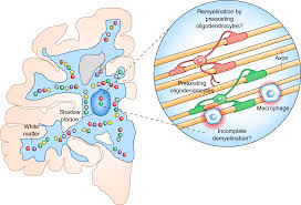 Multiple sclerosis (ms) is an unpredictable disease of the central nervous system that disrupts the flow of information within the brain, and between the brain and body. Time To Revisit Oligodendrocytes In Multiple Sclerosis Nature Medicine
