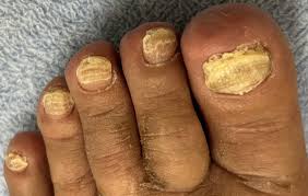 Image result for Beau lines feet