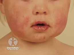 Image result for Papular Acrodermatitis